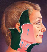 筋膜悬吊——面部无痕提升术